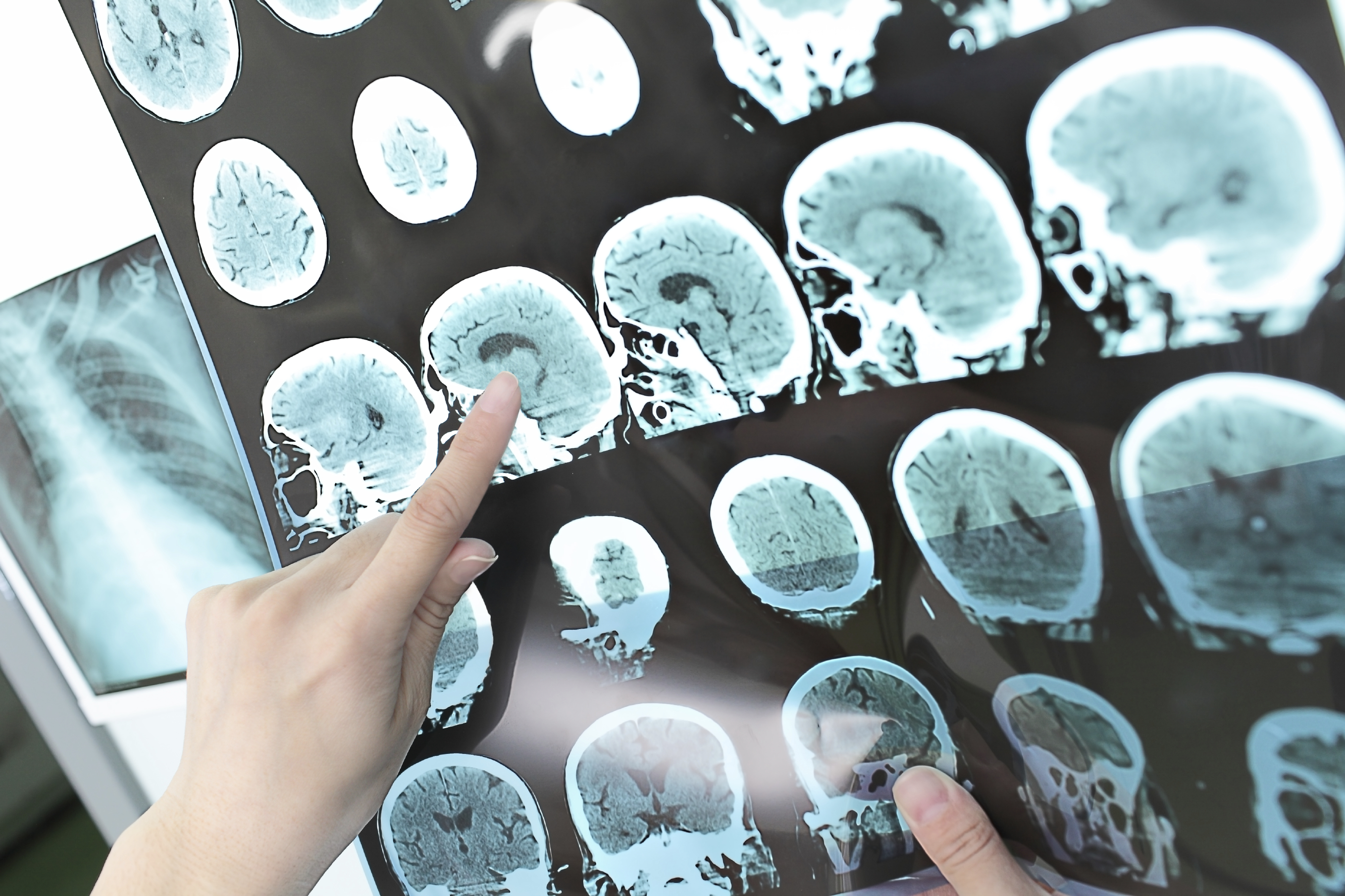 El riesgo genético de Alzheimer se asocia a una alteración lipídica a nivel neuronal