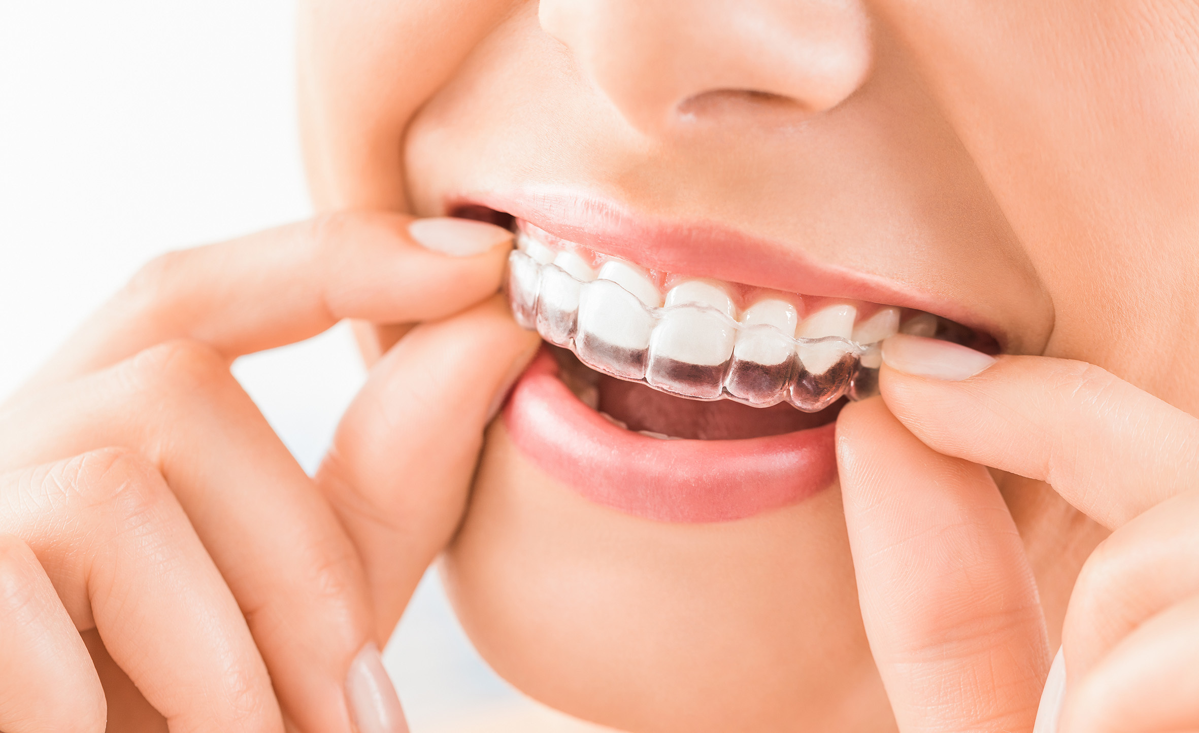 La duración media de un tratamiento con ortodoncia invisible es de 18 meses.