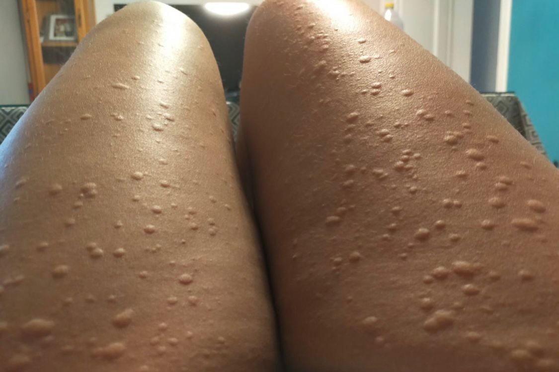 Efectos de la alergia en las piernas
