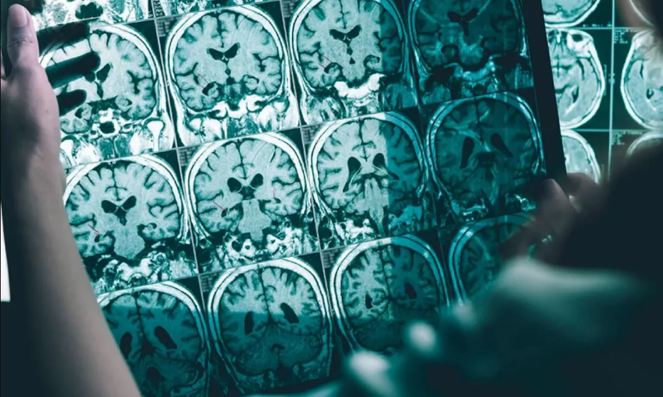 Los estudios han recopilado datos de afectados por Alzheimer en los que se han notado mejorías cerebrales.