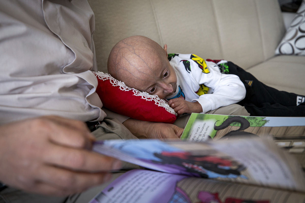Veysel Cozvelioglu, un niño turco de nueve años que sufre progeria.