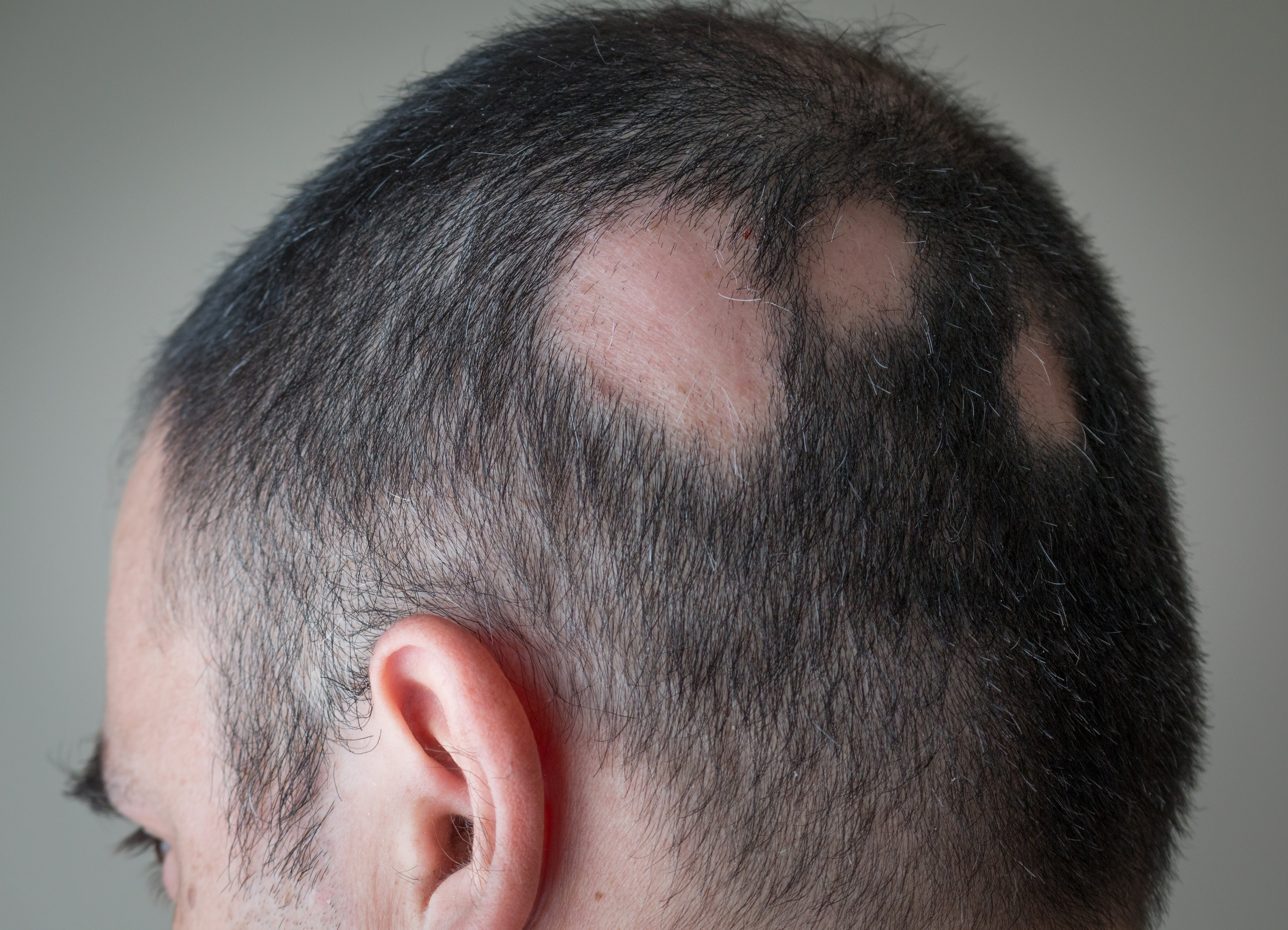 Parches redondos característicos de la alopecia areata.