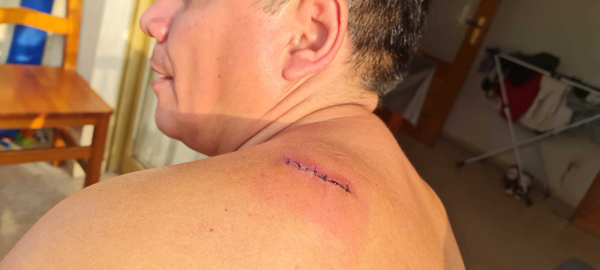 La herida provocada en el omplato de Jorge tras ser acuchillado