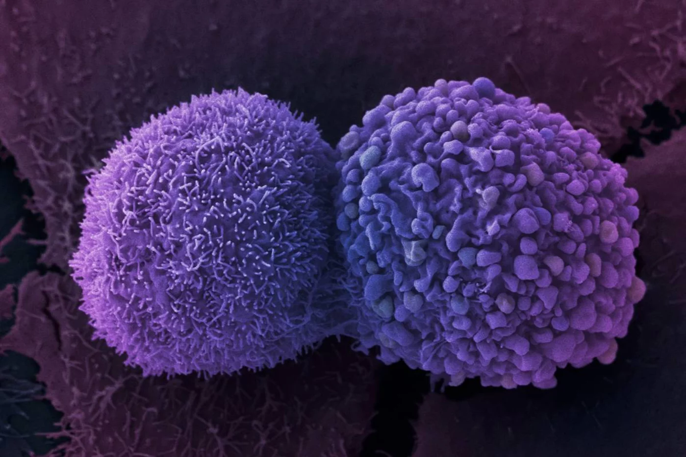 El cáncer de mama puede dirigir su diseminación hacia las células del pulmón.