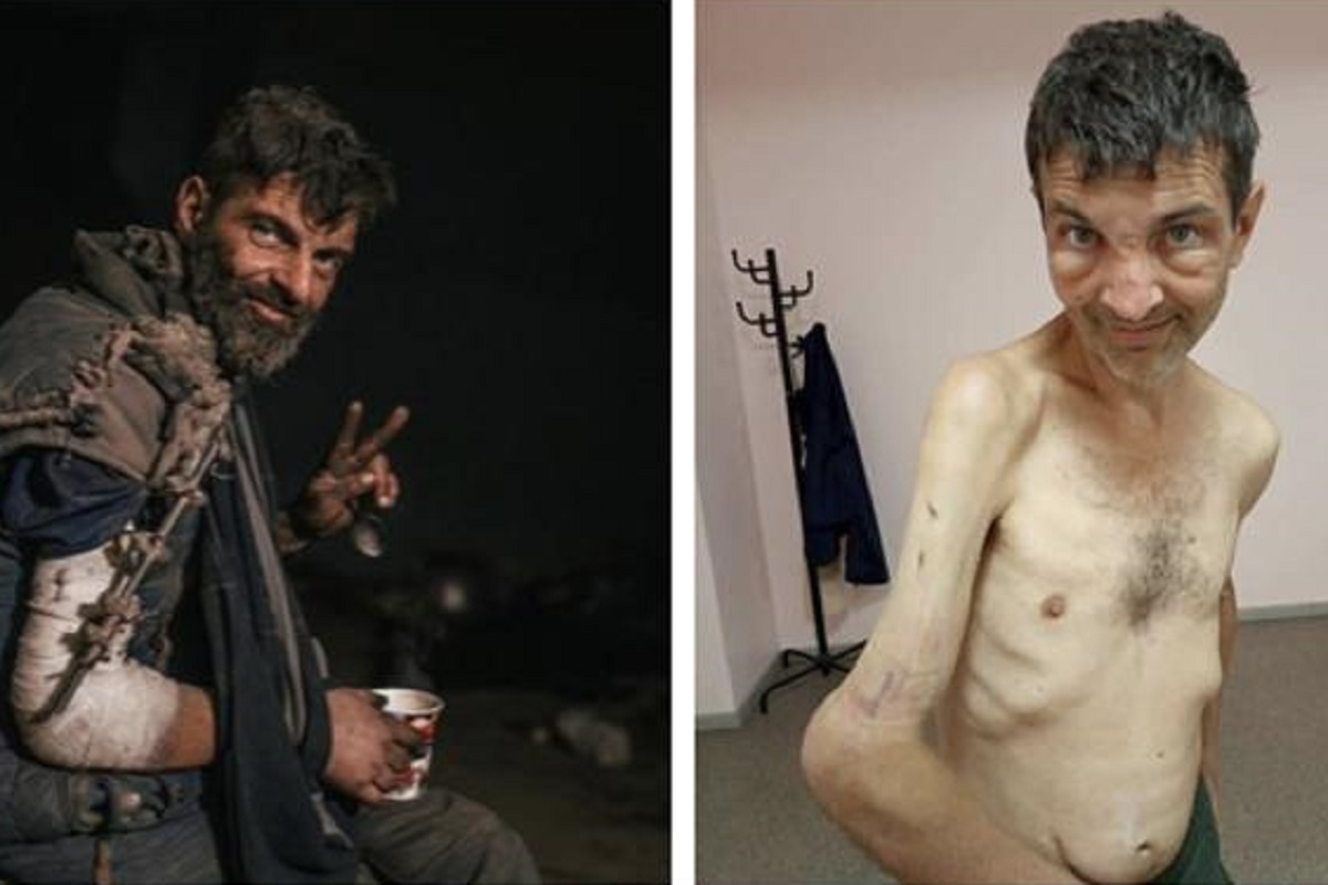 Mykhailo, el luchador de Azovstal, desfigurado tras meses de cautiverio ruso