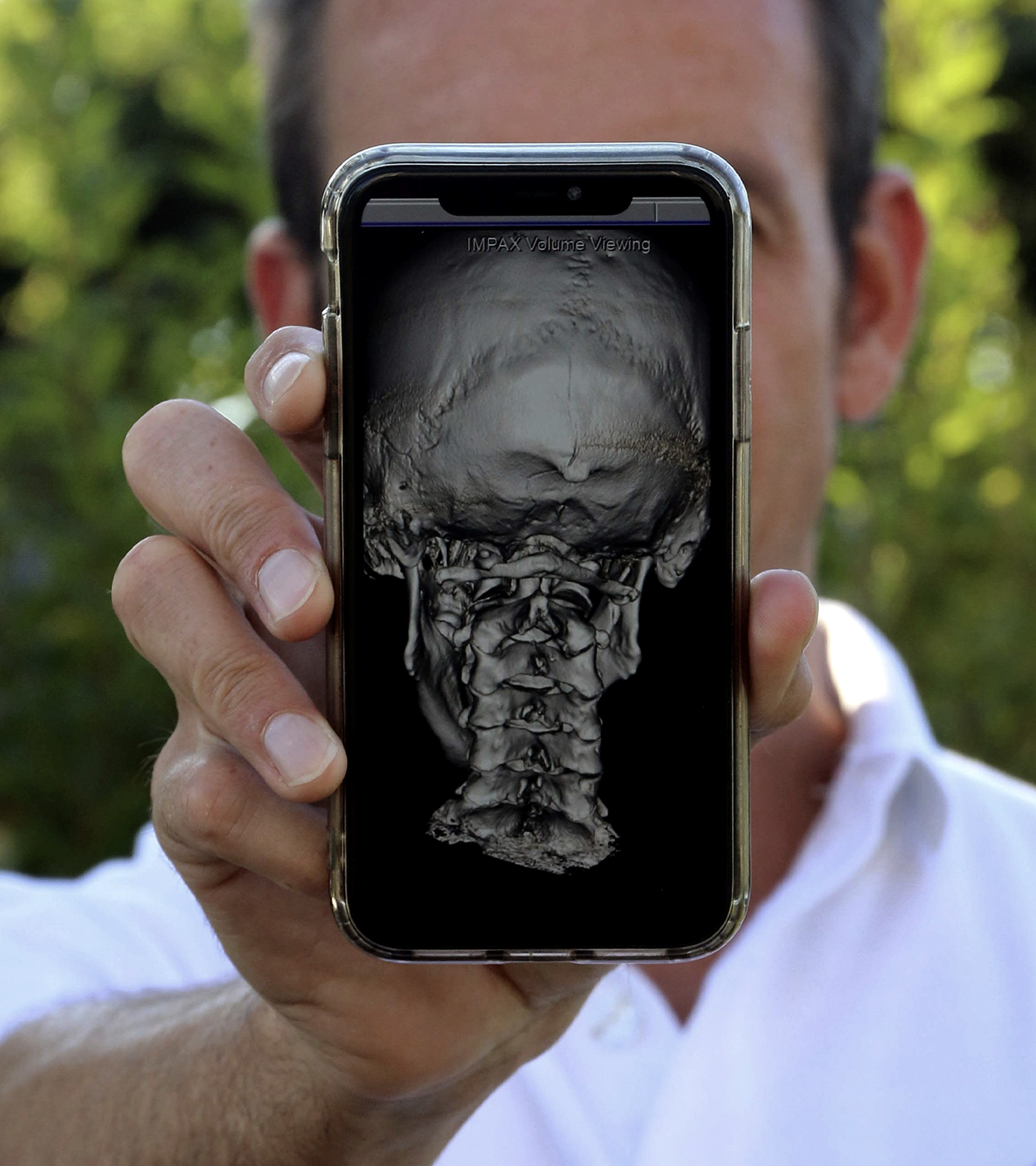 Iván Álvarez Faginas muestra un escáner de su cráneo en el que se ve la fractura que sufrió.