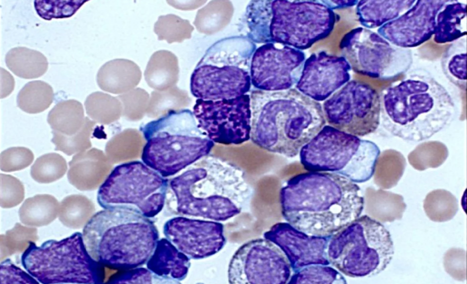 La leucemia es uno de los cnceres de sangre ms frecuentes.