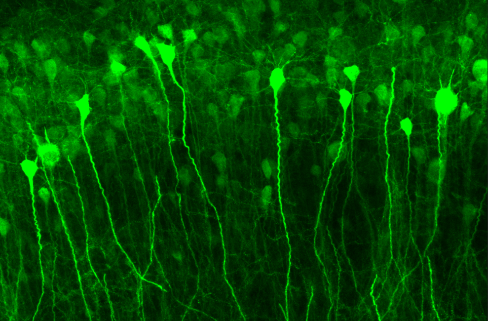 Neuronas del hipocampo activadas por una crisis epiléptica.