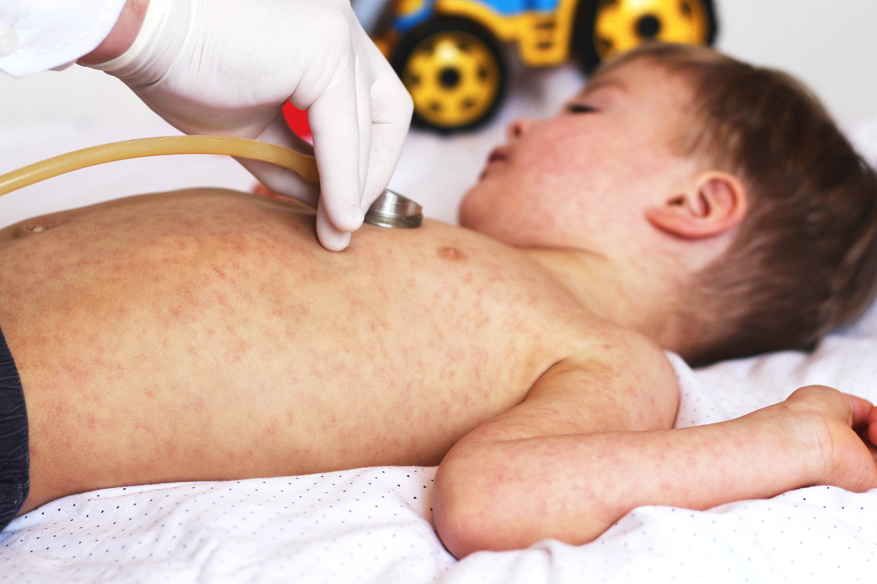Un niño con sarampión es atendido por su médico.