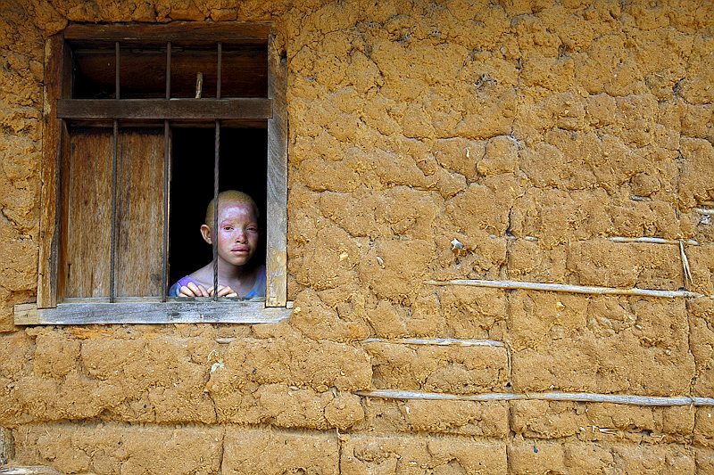Imagen de la exposicin 'Sombras blancas. Viviendo con el albinismo', de Leron Shimoni.