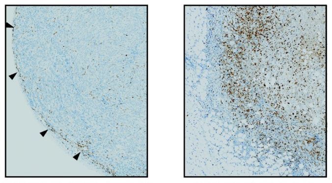 A la izquierda, las clulas CAR-T (puntos marrones) son excluidas de un tumor pancretico inmunodeprimido; a la derecha, las clulas CAR-T mejoradas con IL-2 pueden infiltrarse y matar el tumor pancretico.