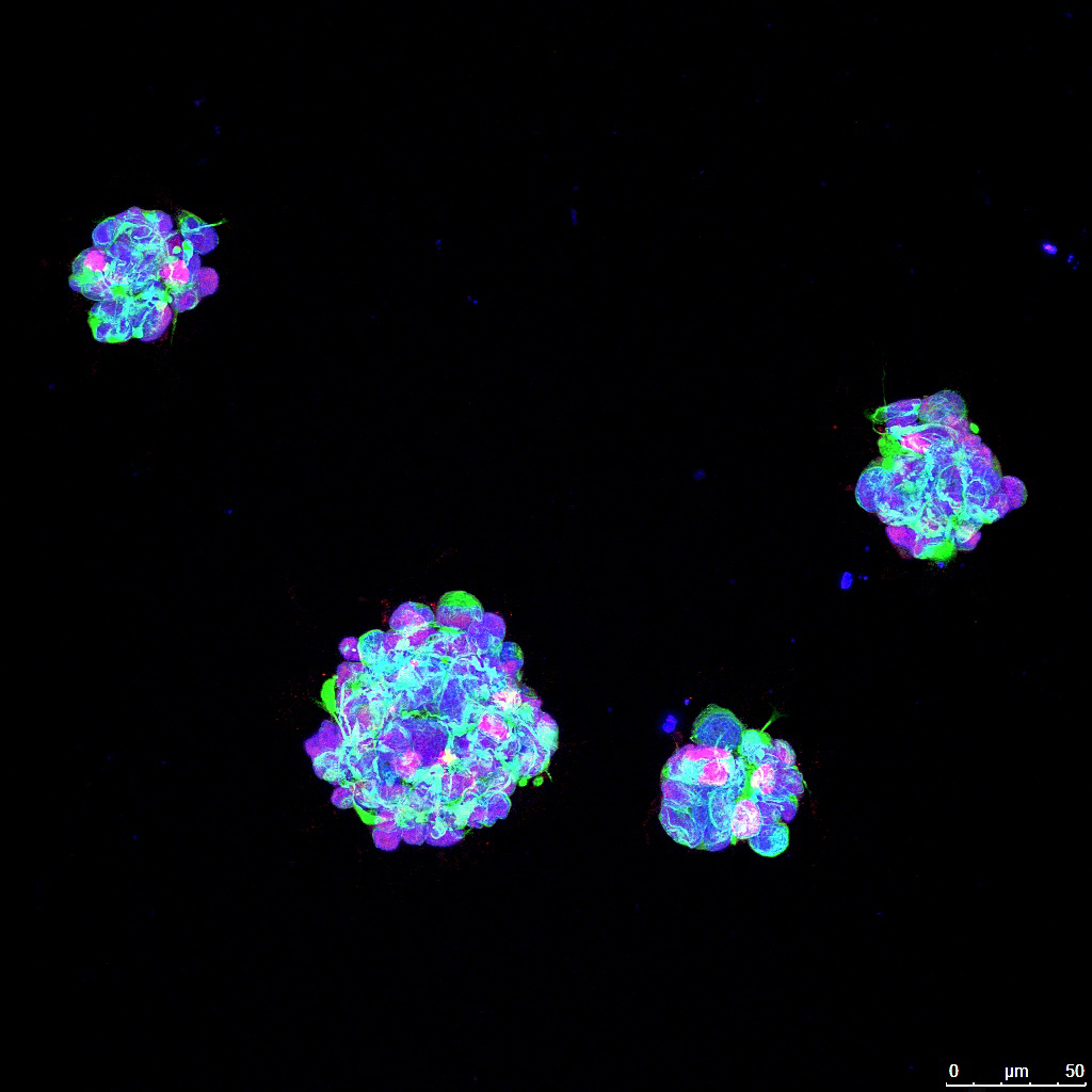 Imagen de microscopia confocal de un cultivo de células iniciadoras de tumor derivadas de un paciente con glioblastoma.