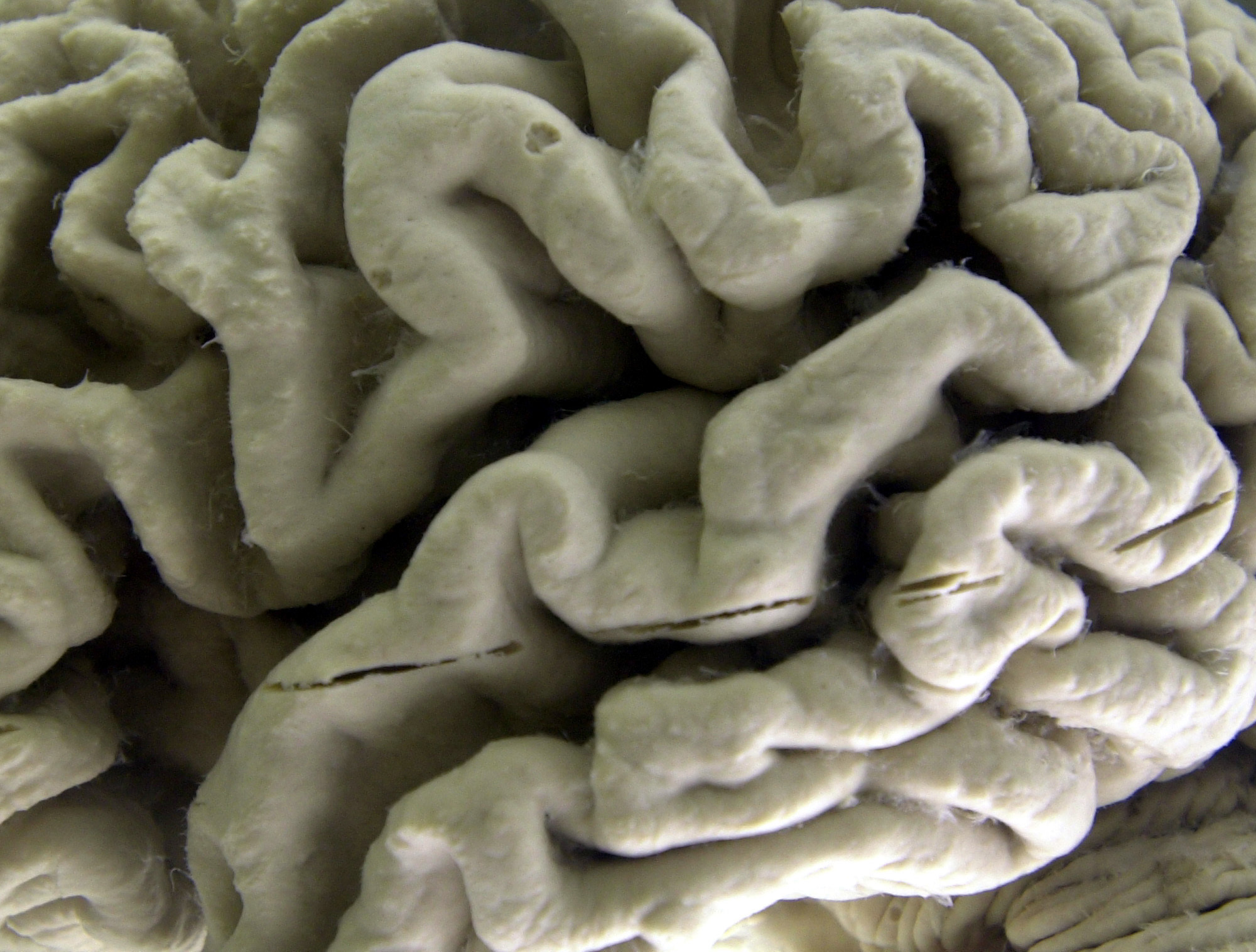 Imagen de un cerebro afectado por alzhéimer (2003)