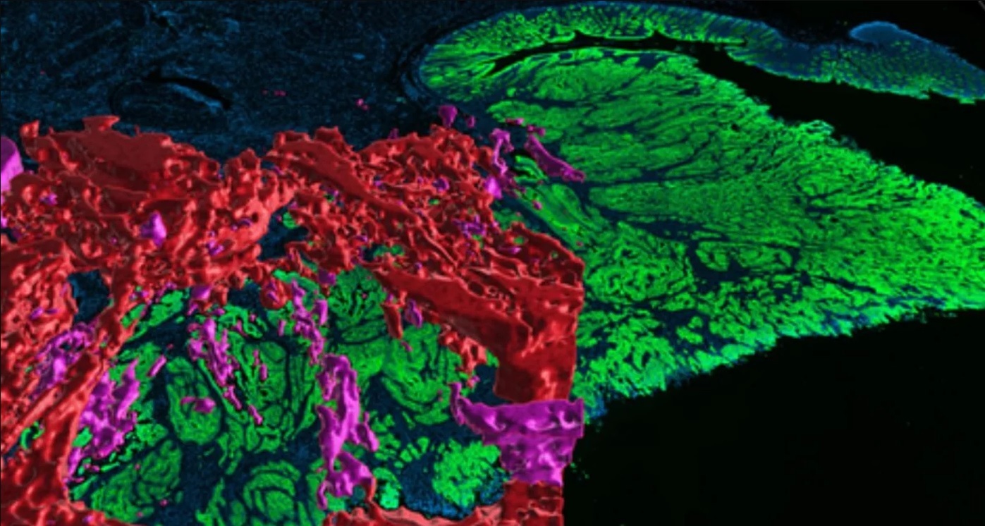 La imagen 3D muestra una red compleja y extensa de canales y cavernas (en rojo y rosa) con células cancerígenas que forman proyecciones en forma de dedos (no visibles).