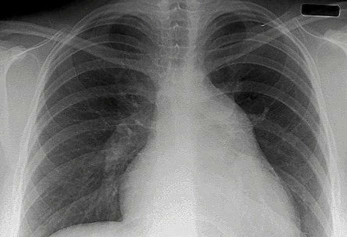 Una imagen de un cáncer de pulmón.