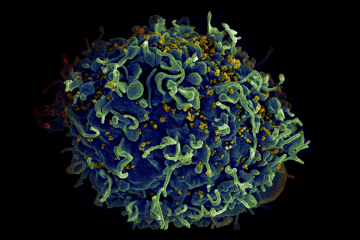 Partículas de VIH infectando una célula T, del sistema defensivo humano.