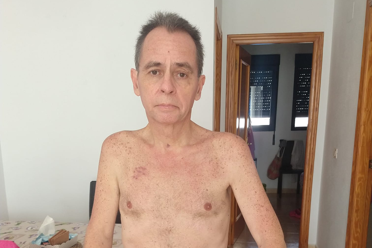 Gustavo Maestre  tras salir del hospital con 35 kilos menos y secuelas. C.A.D.