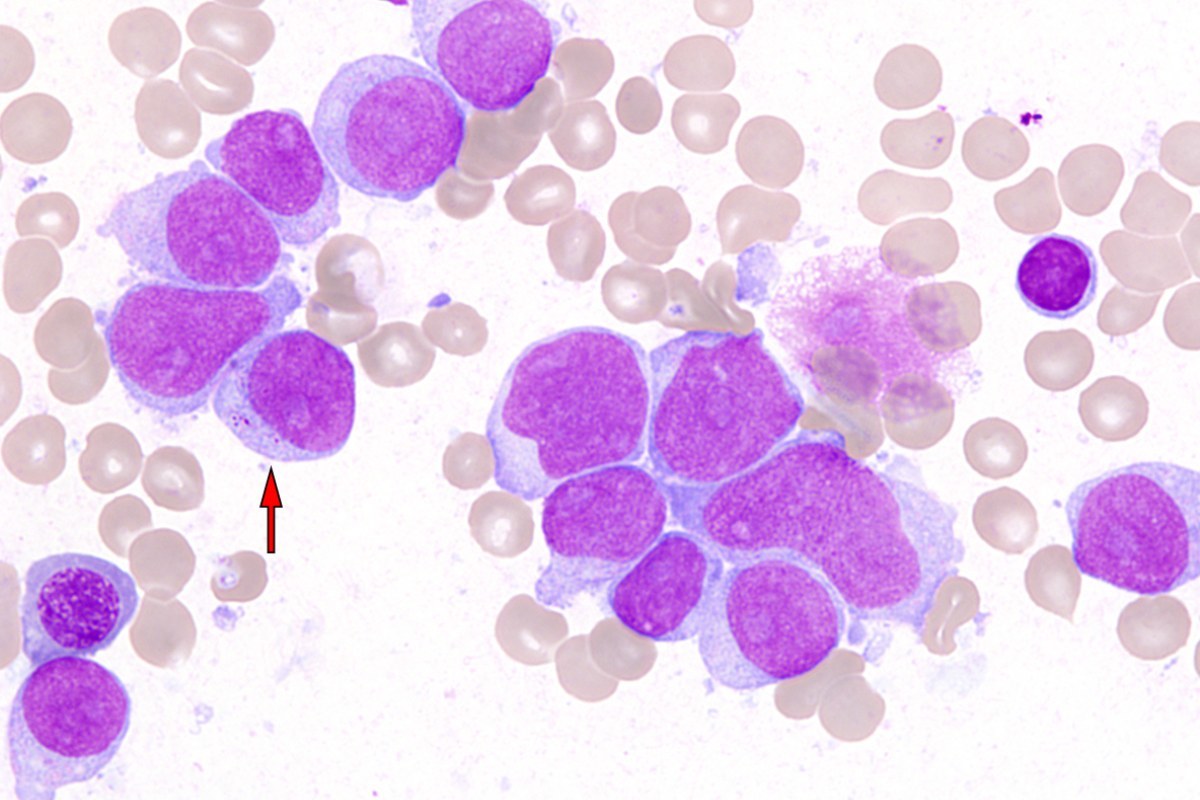 Imagen histológica de leucemia mieloide aguda.