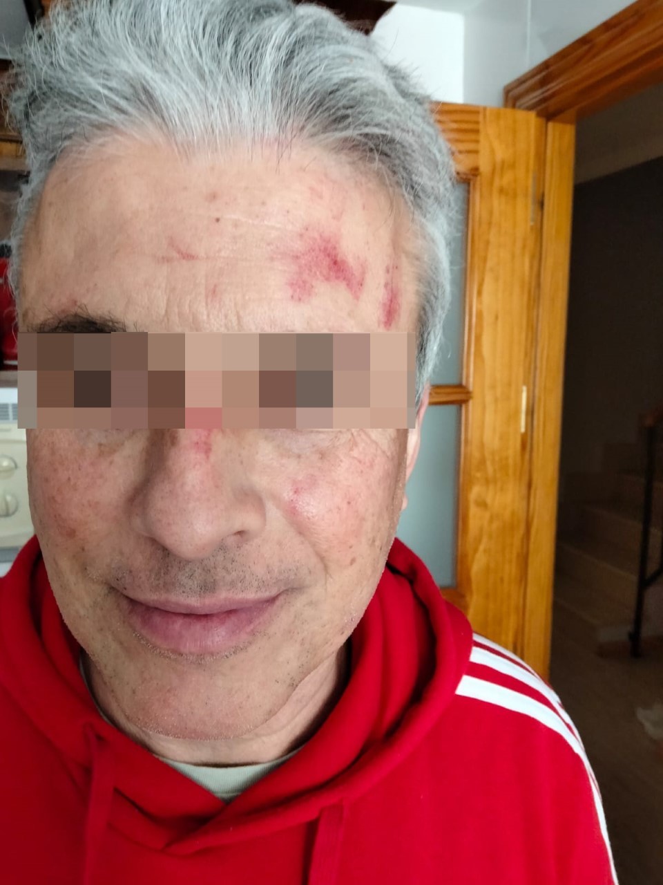 Heridas en la cara que sufrió uno de los agentes tres días después de los hechos.