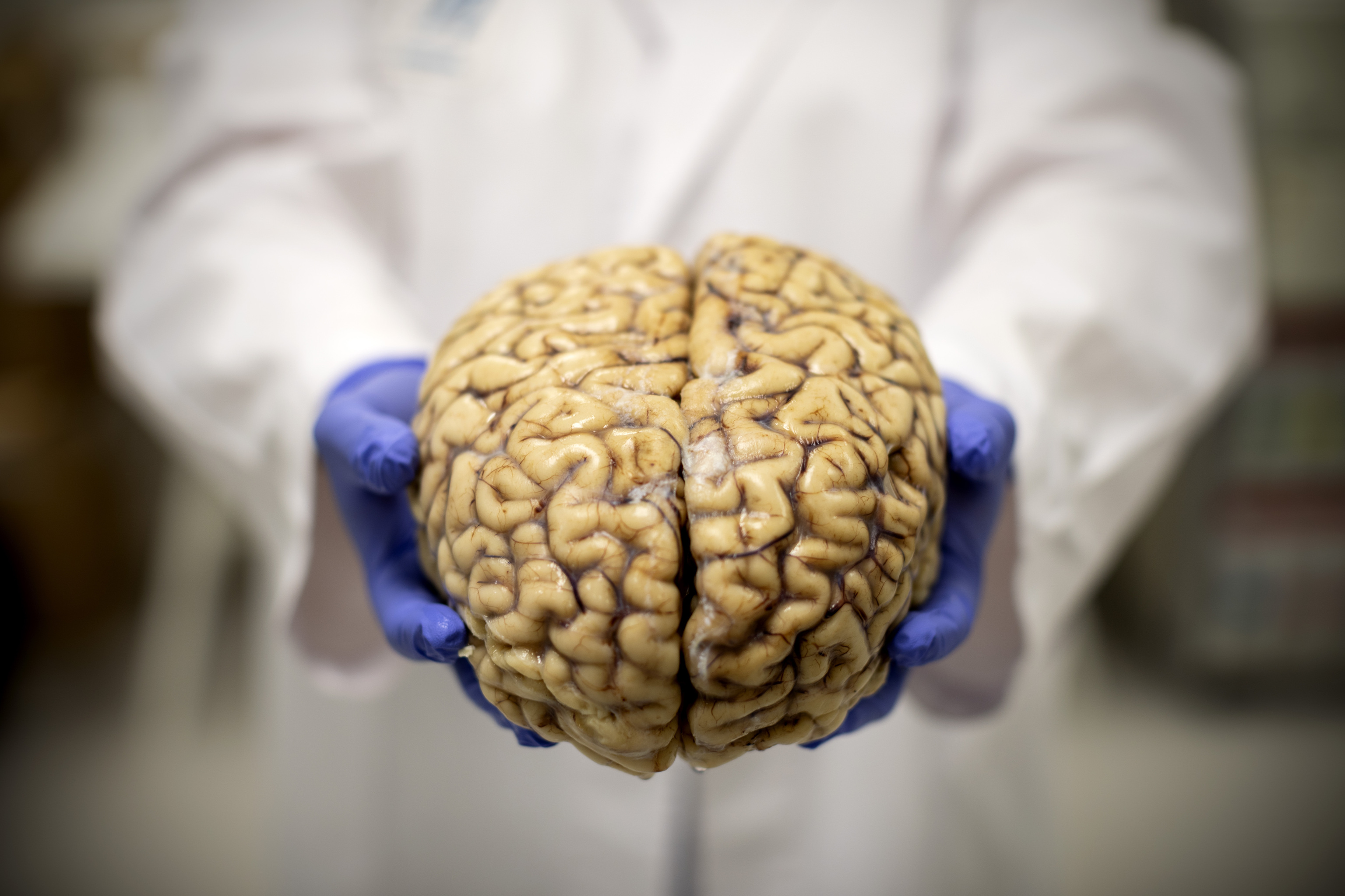 Imagen de un cerebro humano del banco de cerebros de la Fundación CIEN de Madrid.