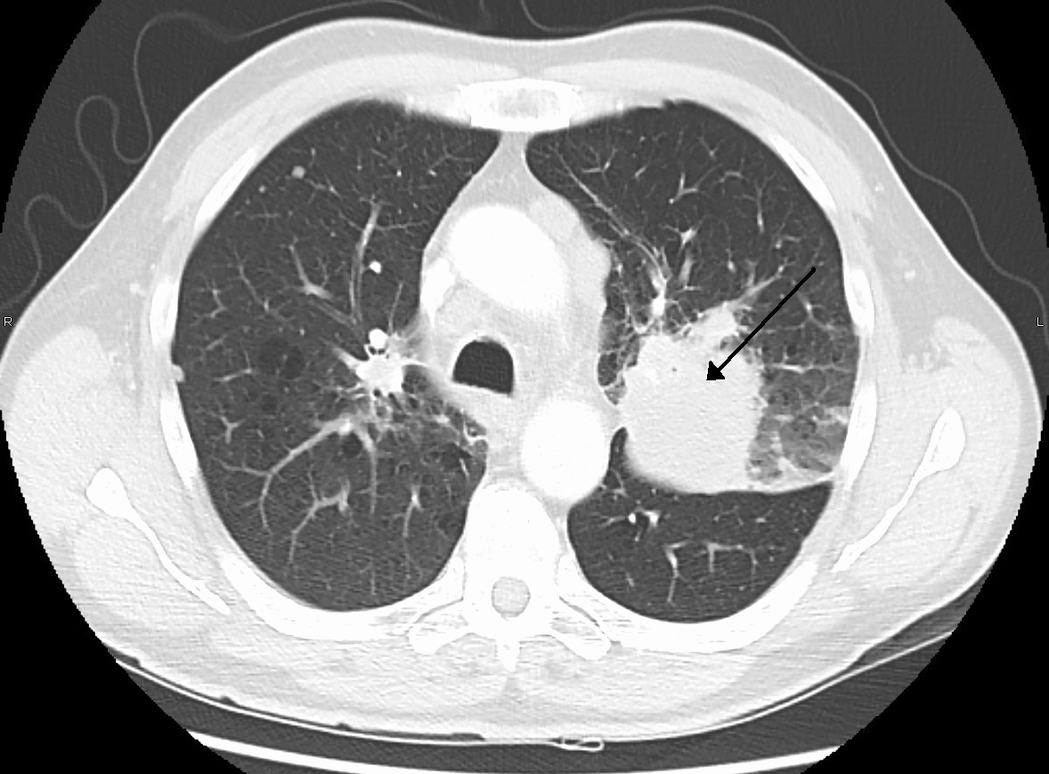 Escáner (tomografía computerizada) de un cáncer de pulmón.
