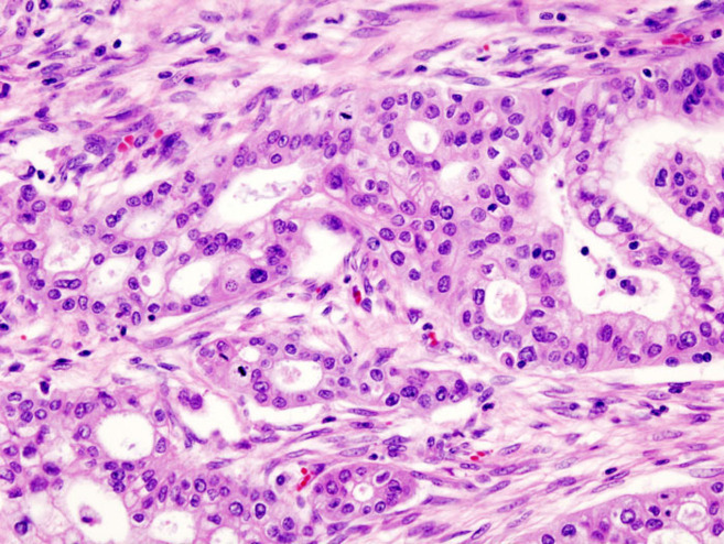 Células de adenocarcinoma ductal de páncreas, el tipo de tumor más común en este órgano.