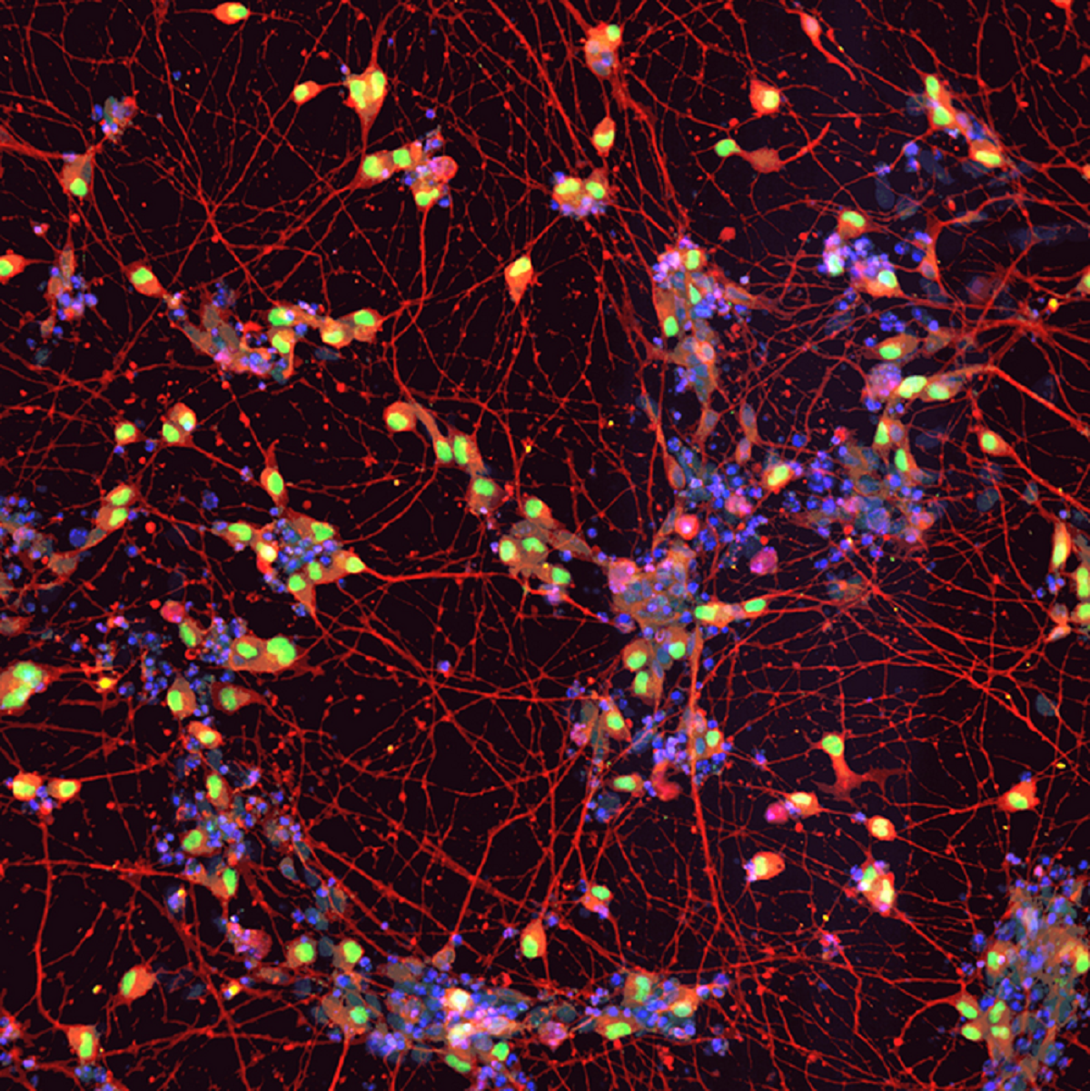 Neuronas motoras de un paciente con ELA