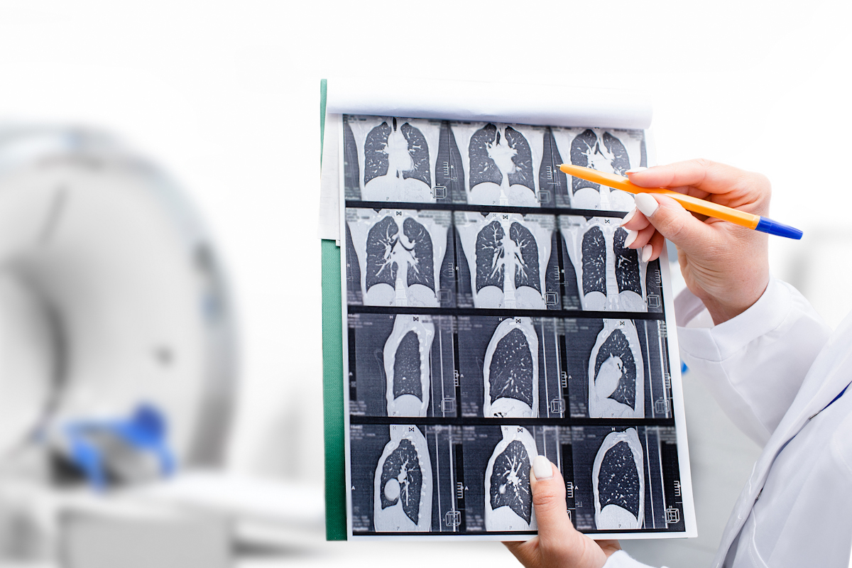 Un radiólogo muestra una tomografía escaneada de los pulmones de un paciente.