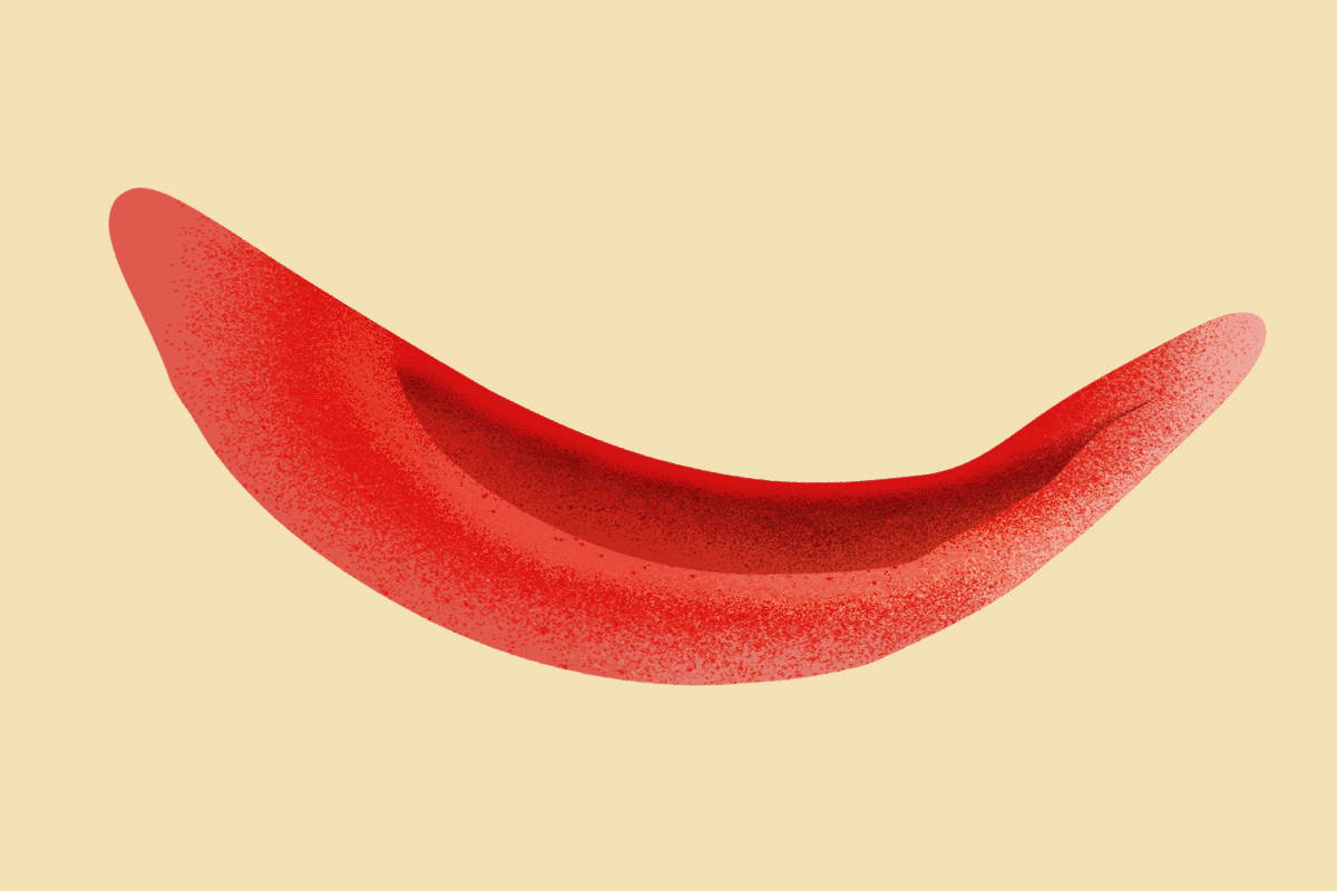 Detalle de un glbulo rojo en un afectado de enfermedad de clulas falciformes.