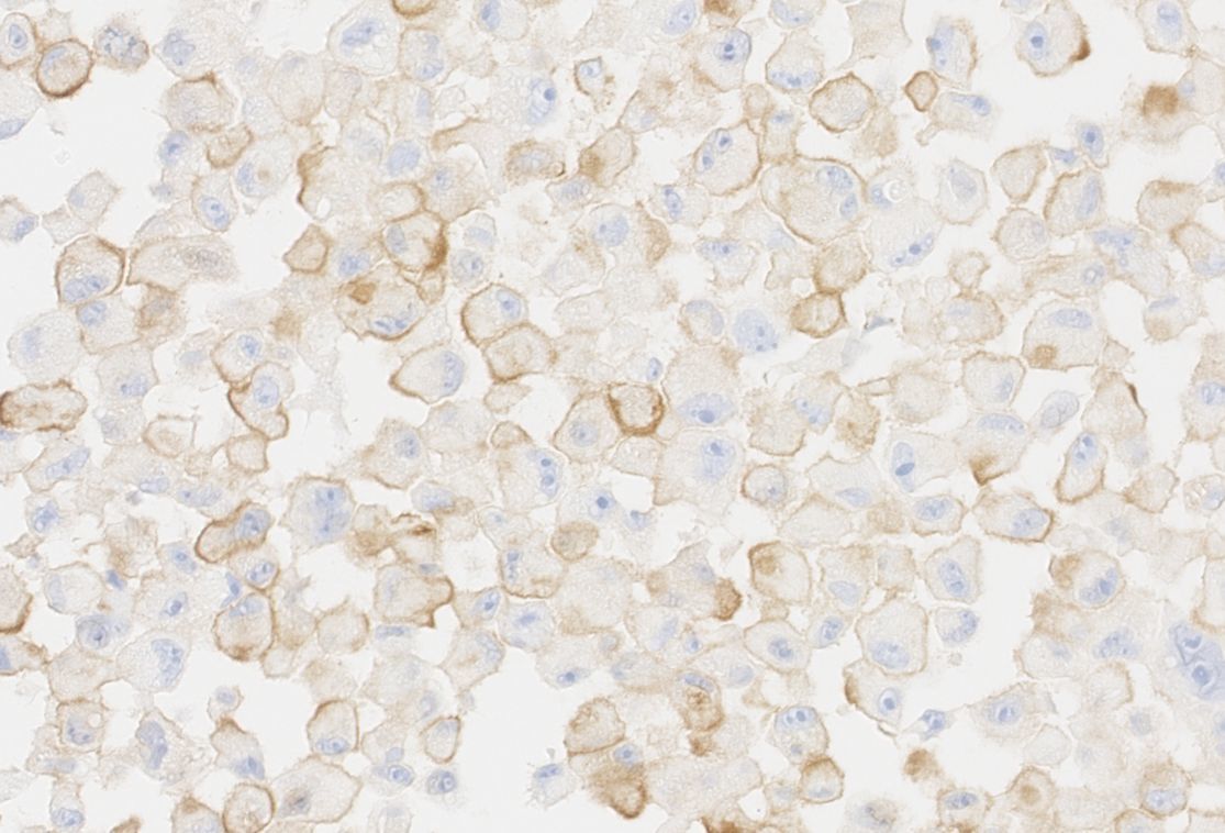 Clulas tumorales senescentes de melanoma humano. En marrn, la protena PD-L2 que acta de escudo protector y evita la accin del sistema inmune.