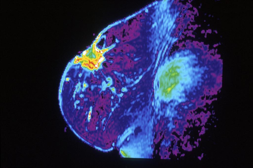 Mamografa de un pecho que tiene un tumor.