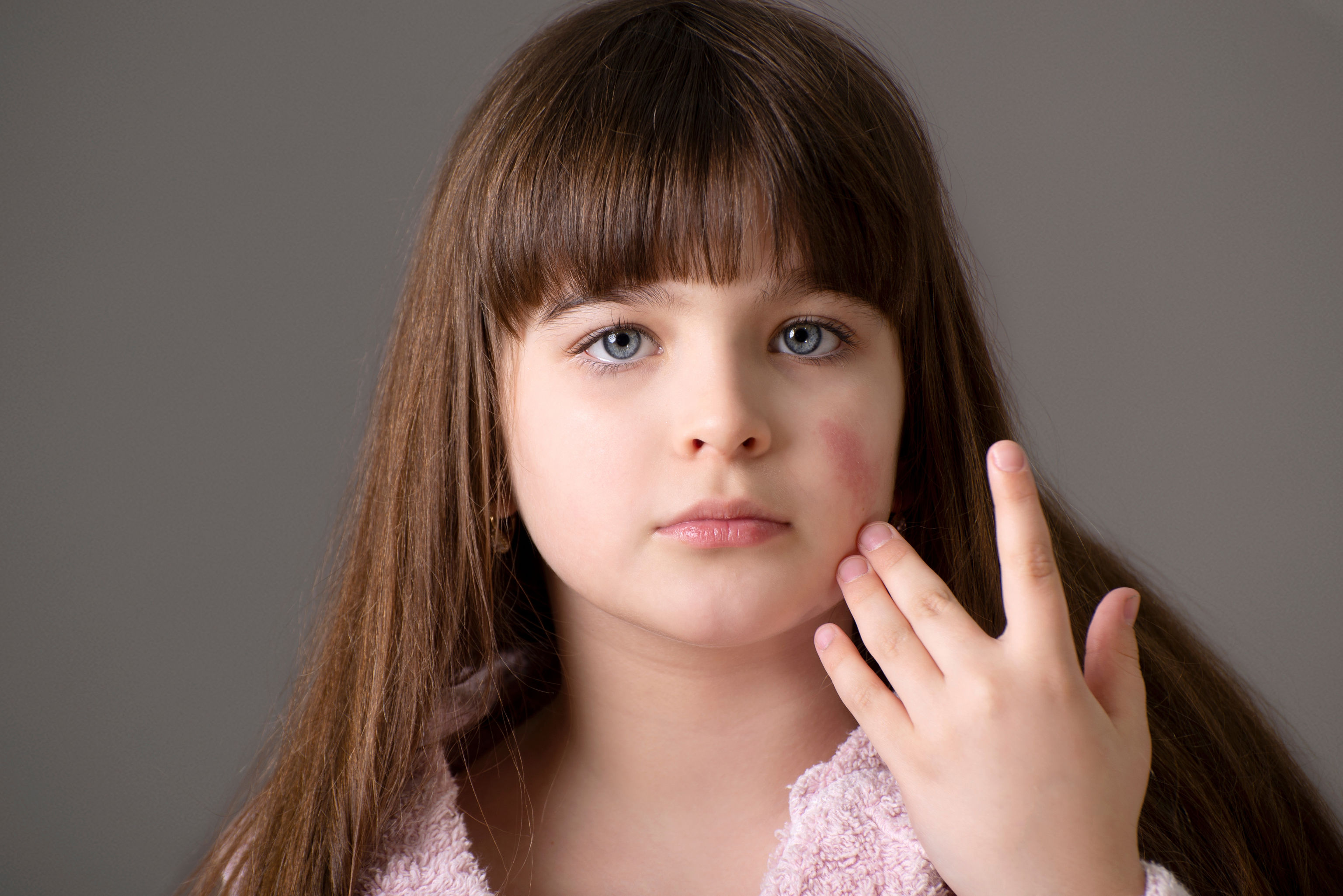 Una niña muestra un eccema facial.