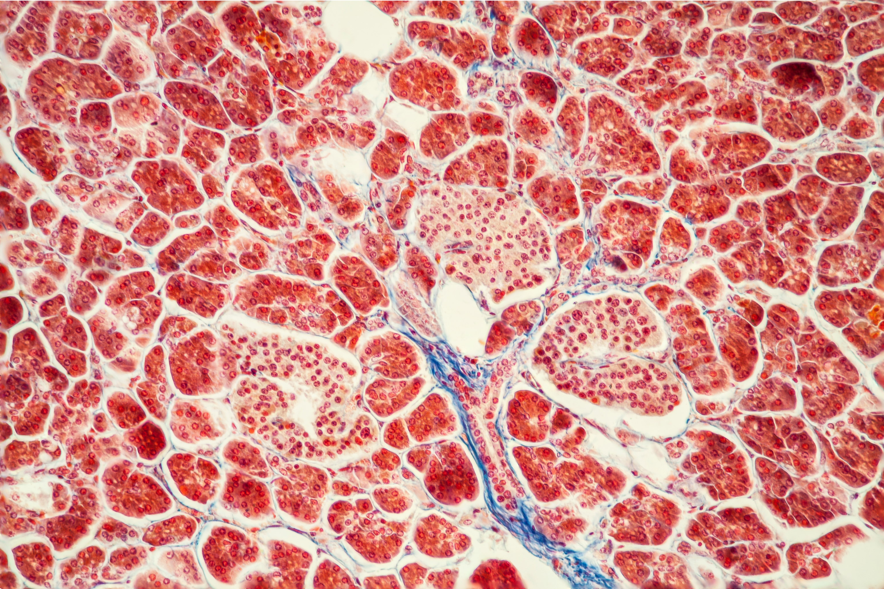 Así es el revolucionario fármaco para cáncer de páncreas que ya empieza a beneficiar al enfermo