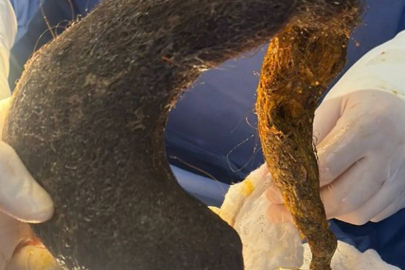 Síndrome de Rapunzel, el extraño trastorno que llevó a una mujer al quirófano para extraerle una bola de pelo que ocupaba el 90% de su estómago