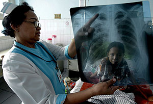 Una enfermera muestra la radiografa de una nia con tuberculosis en Indonesia. (Foto: EFE)
