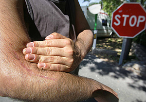 Un inmigrante maltratado por la Polica Nacional, muestra las secuelas de la paliza recibida. (Foto: Enrique Carrascal).