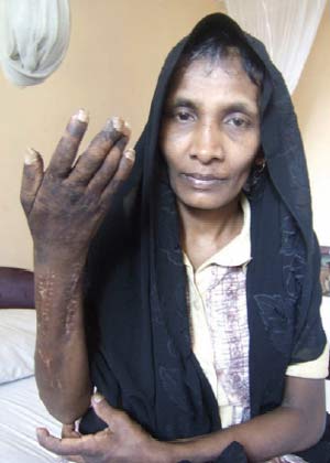 Una trabajadora doméstica que ha denunciado abusos de sus empleadores en Kuwait. (Foto: HRW)
