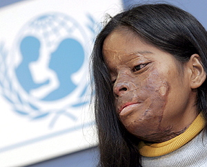 La joven Hasina Akter, vctima de un ataque con cido a los 17 aos. (Foto: EFE)