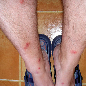 En la imagen el resultado del ataque de las pulgas a este ciudadano (Foto: Sebastin Lpez)