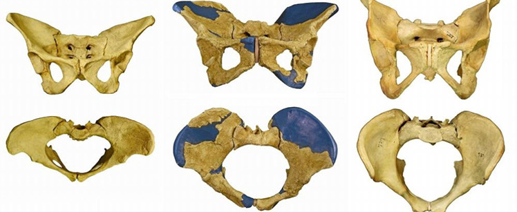 Comparación entre la pelvis de Lucy (izquierda) con la encontrada en Gona (centro) y la de un humano moderno (derecha). (Foto: 'Science')