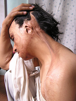 Malalai, con la cara y el cuerpo quemados como consecuencia de un obús de mortero. (Foto: M. B.)