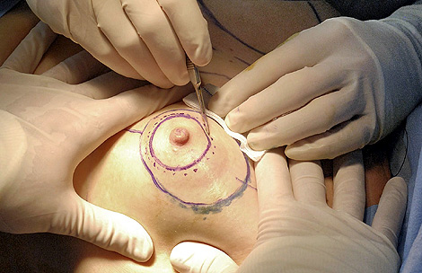 Imagen de una operacin de aumento de mamas.