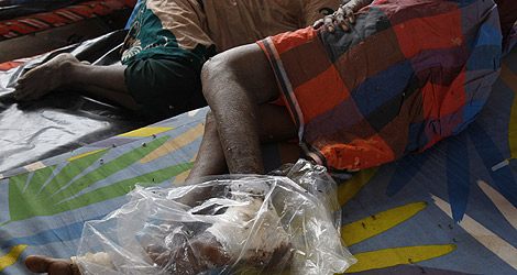 Un hombre con el pie destrozado en un hospital de Vavuniya. | Ap