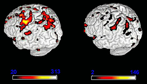 Cerebro. Cerebro. A travs de la biosimulacin y los nuevos programas de imagen puede verse cmo se activan las diferentes zonas del cerebro tras la realizacin de una resonancia magntica funcional. Tambin pueden simular los efectos de enfermedades como Parkinson.