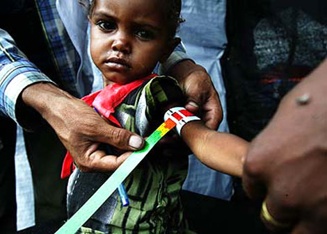 Millones de nios mueren de desnutricin | MSF