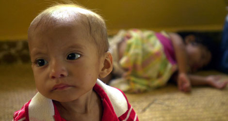 Un beb desnutrido espera recibir su comida en un hospital al noreste del pas | Ap