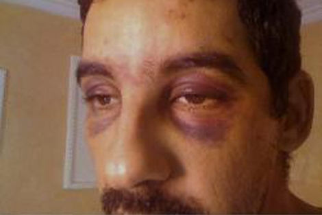 Ahmed Yeddou Salem Lecuara muestra sus heridas. | Fundacin Shara Occidental