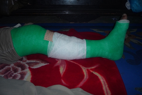 La pierna vendada de uno de los detenidos por Marruecos. | Ana Romero