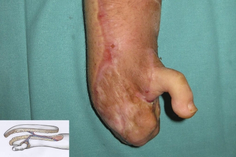El dedo gordo del pie implantado en la mano de la paciente. | Efe