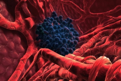 Una clula cancerosa en un hgado humano. | Global Cancer News